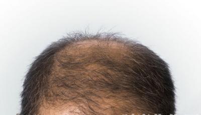 男性脱发有什么好方法治疗
