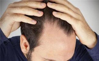 每天掉100根头发会影响你的身体吗？