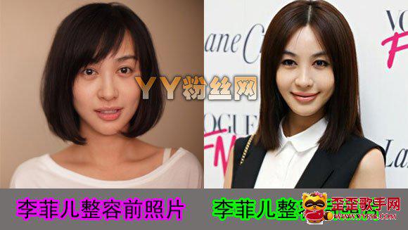 李菲儿整容经历,李菲儿整容前后照片对比