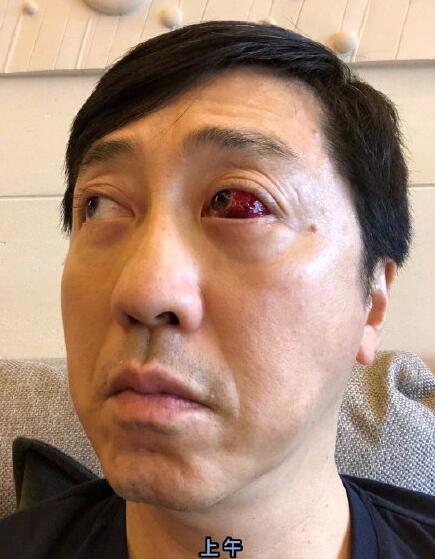 庾澄庆眼睛受伤在微博晒出眼睛受伤的照片 这个受伤的眼睛好吓人