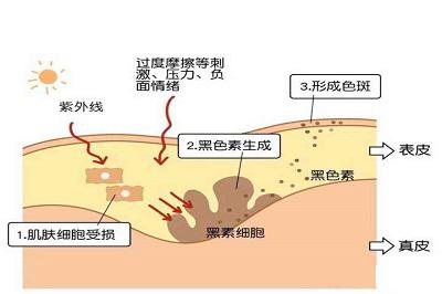 黑色素瘤早期症状图片 告诉你三大症状