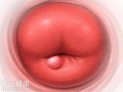 宫颈囊肿是怎么回事 【专家提醒】女性宫颈囊肿不需过于恐慌