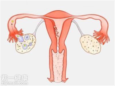 卵巢大小正常范围是多少 揭示左右侧大小一致吗