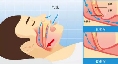 睡觉打呼噜的人为什么吵不醒自己