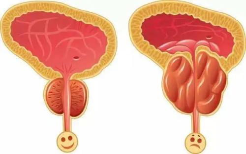 男性前列腺炎能过性生活吗？需要注意什么