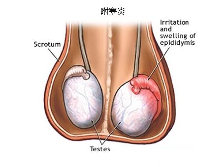 蛋蛋疼痛？可能你有附睾睾丸炎