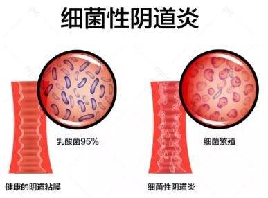 女孩子内裤总是湿哒哒 下面水太多也是一种烦恼！