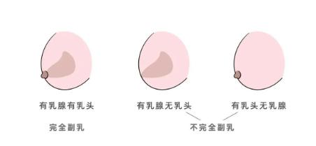 女生可能不止有一对乳房，副乳也能分泌乳汁