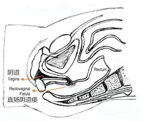 房事的时候下面总有声音，是因为太松了吗