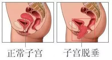 女性产后1个月迅速恢复紧致
