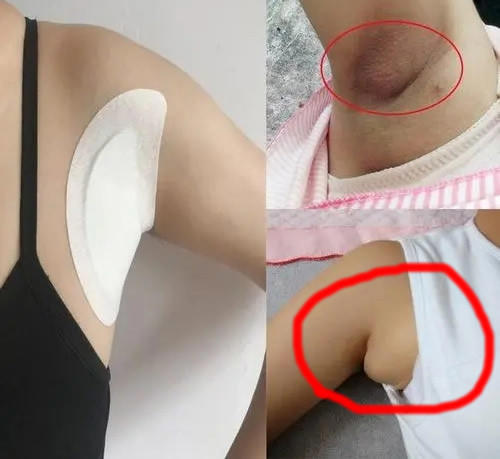 女性副乳长什么样子图片(先天副乳和后天副乳要分清)