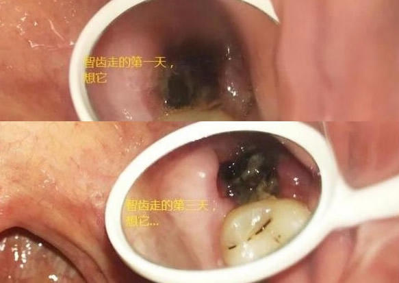 拔牙10天后牙窝状态图(拔牙一周状态及恢复情况)